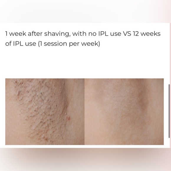Lux skin permanent laser hair removal main image 4